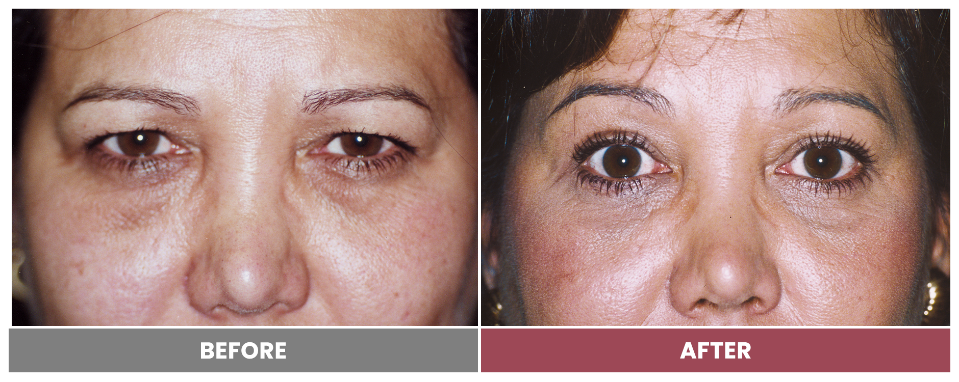 Upper Blepharoplasty - Case 78